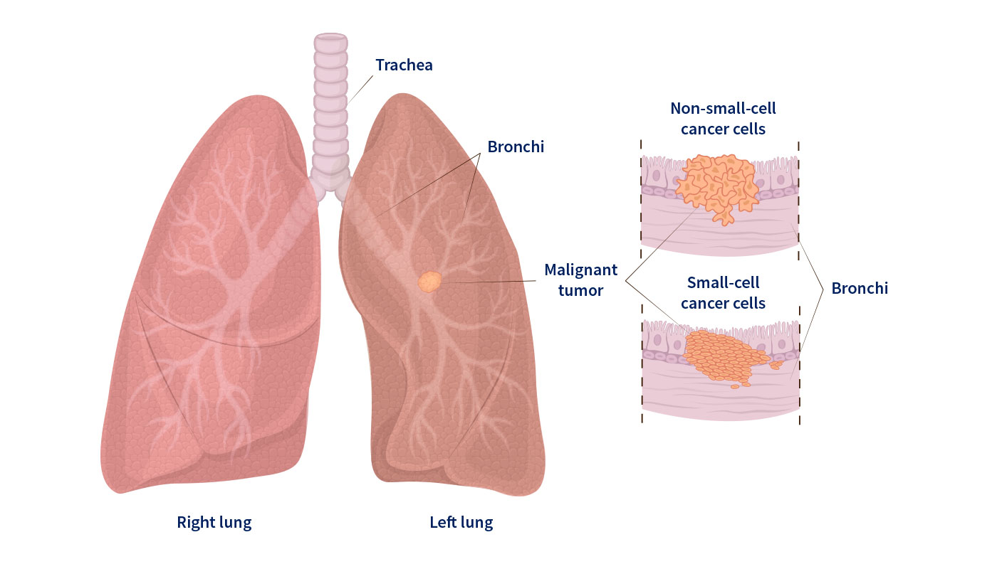 West_FL_Non-Small-Cell-Lung-Cancer