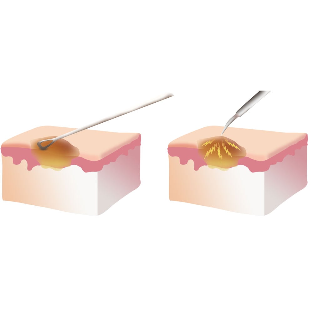 West_FL_Skin-Cancer_Curettage_Electrodesiccation