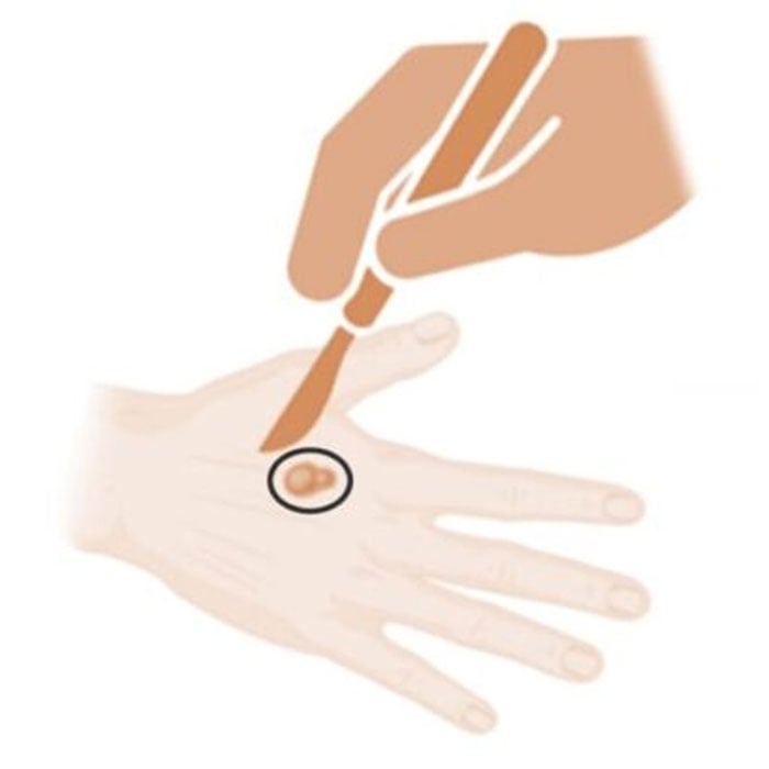 West_FL_Skin-Cancer_Wide-Local-Excision